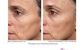 ThermaFrax Anti Aging Treatments